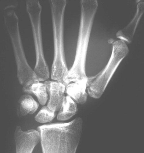 原创苯奈特骨折的解剖板治疗